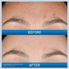 https://cdn.shopify.com/s/files/1/1291/3633/files/beforeandafterofCeraVeResurfacingRetinolSerumForPost-AcneMarks.png?v=1759742789